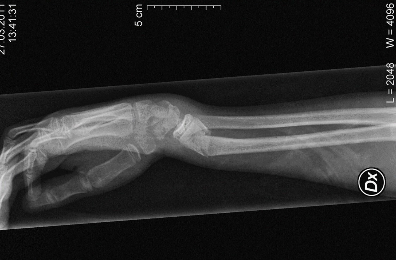 Stein Vabo, Røntgenbilde av et håndleddsbrudd, som er en vanlig skade i skibakken., Håndleddsbrudd illustrasjonsfoto 1, , 