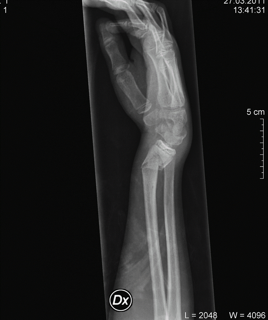 , , Konservativ bruddbehandling, ,